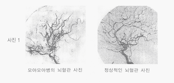 모야모야병의 뇌혈관 사진과 정상 뇌혈관의 사진