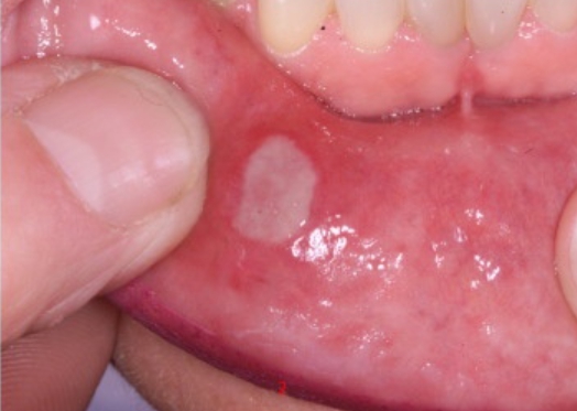 구내염이 자주 생기는 이유와 해결책