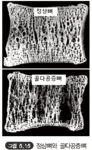 골다공증