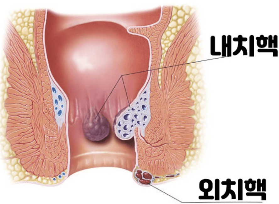 치질 수술 방법&amp;#44; 치질 방석&amp;#44; 치질에 좋은 배변 습관과 음식 추천 2편!