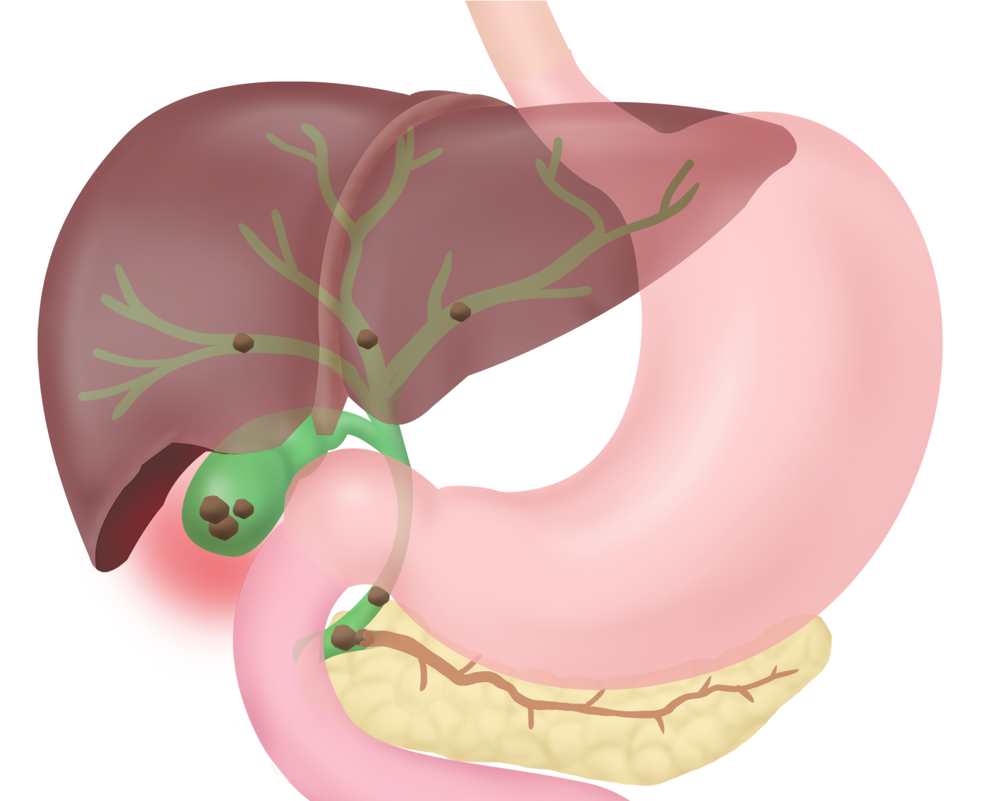 인체의 내부 장기 중에서 간과 위장, 담낭, 비장을 그린 이미지 중에서 담낭에 담석이 생겨서 혈관을 타고 다니면서 혈관을 막고 있는 이미지