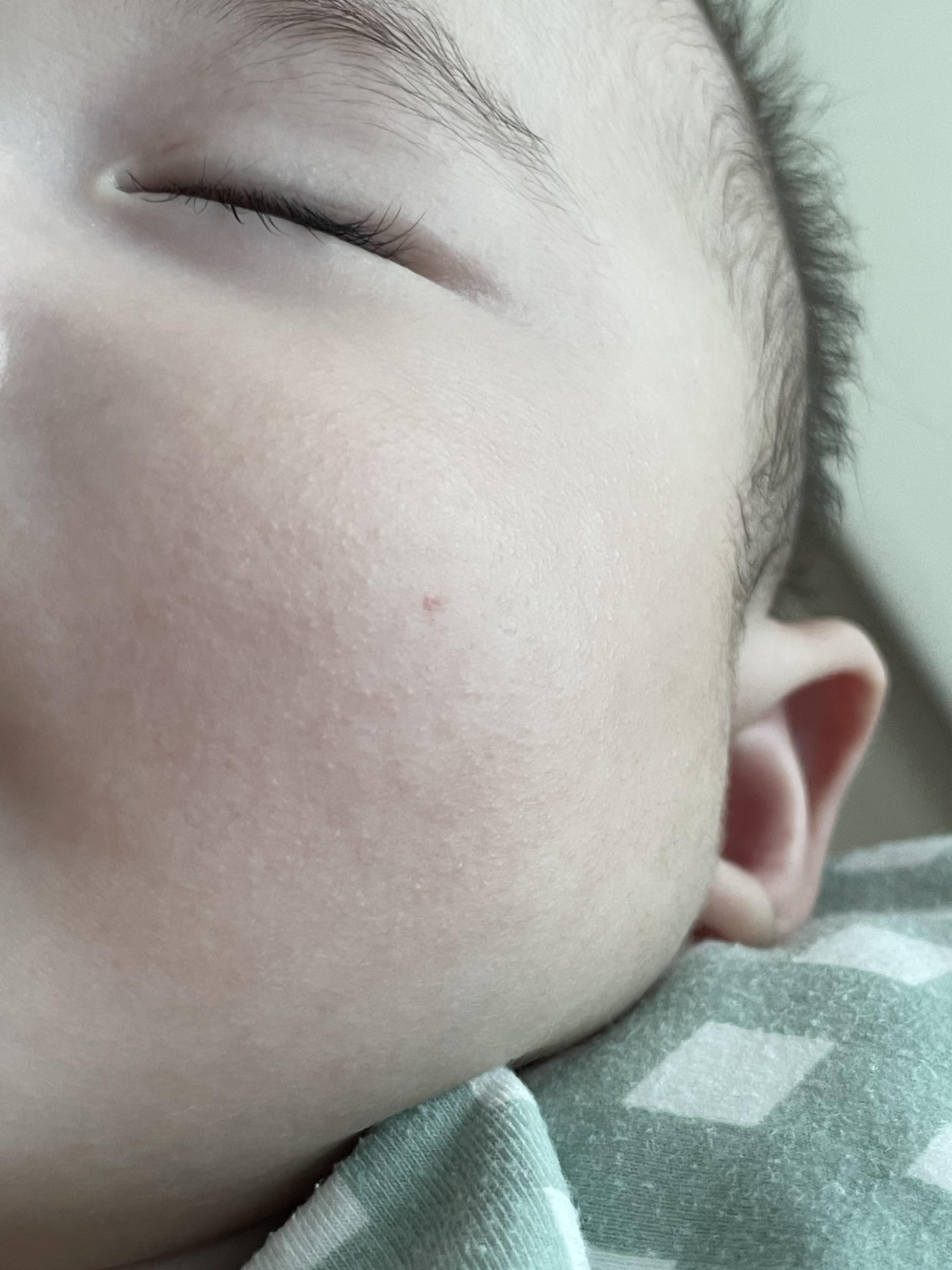 혈관종 에스앤유 피부과