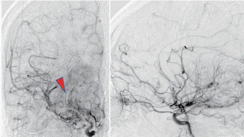 모야모야병(Moyamoya Disease, MMD) 최신 치료법과 향후 전망