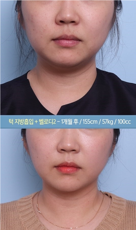 턱살지방흡입 후기