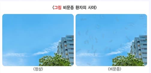 비문증 원인 증상 치료방법 알아보기