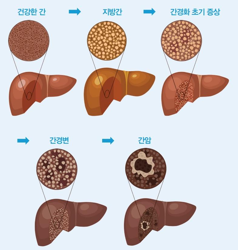 간경변과 간암 진행단계