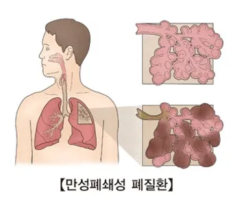 폐질환의 종류 7가지와 예방법 건강관리 필수_2