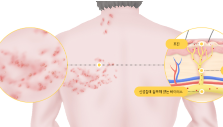 대상포진 예방접종
