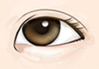 몽고주름