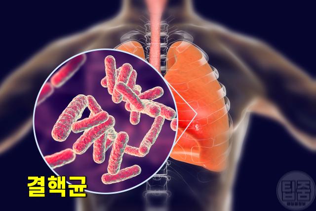 결핵 초기증상,면역력,팁줌