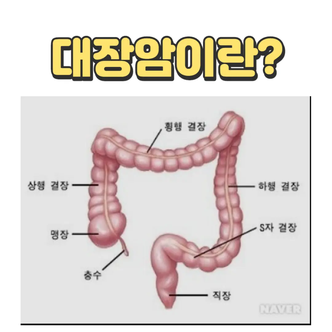 대장암이란