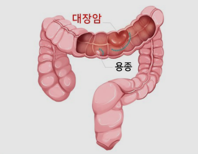 대장암