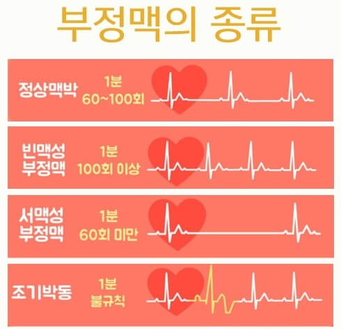 부정맥의 종류