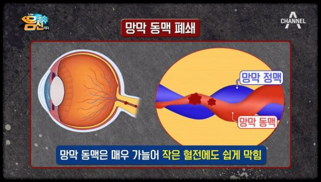 눈으로 보는 건강 신호: 갑상선저하증부터 폐암까지 안질환 증상 파헤치기