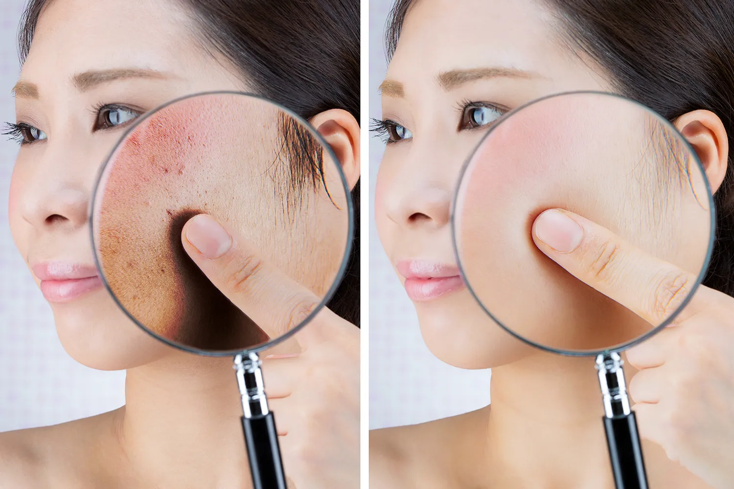 거울에 비친 기미, 색소 멜라닌 주근깨를 보고 속상해하는 여성