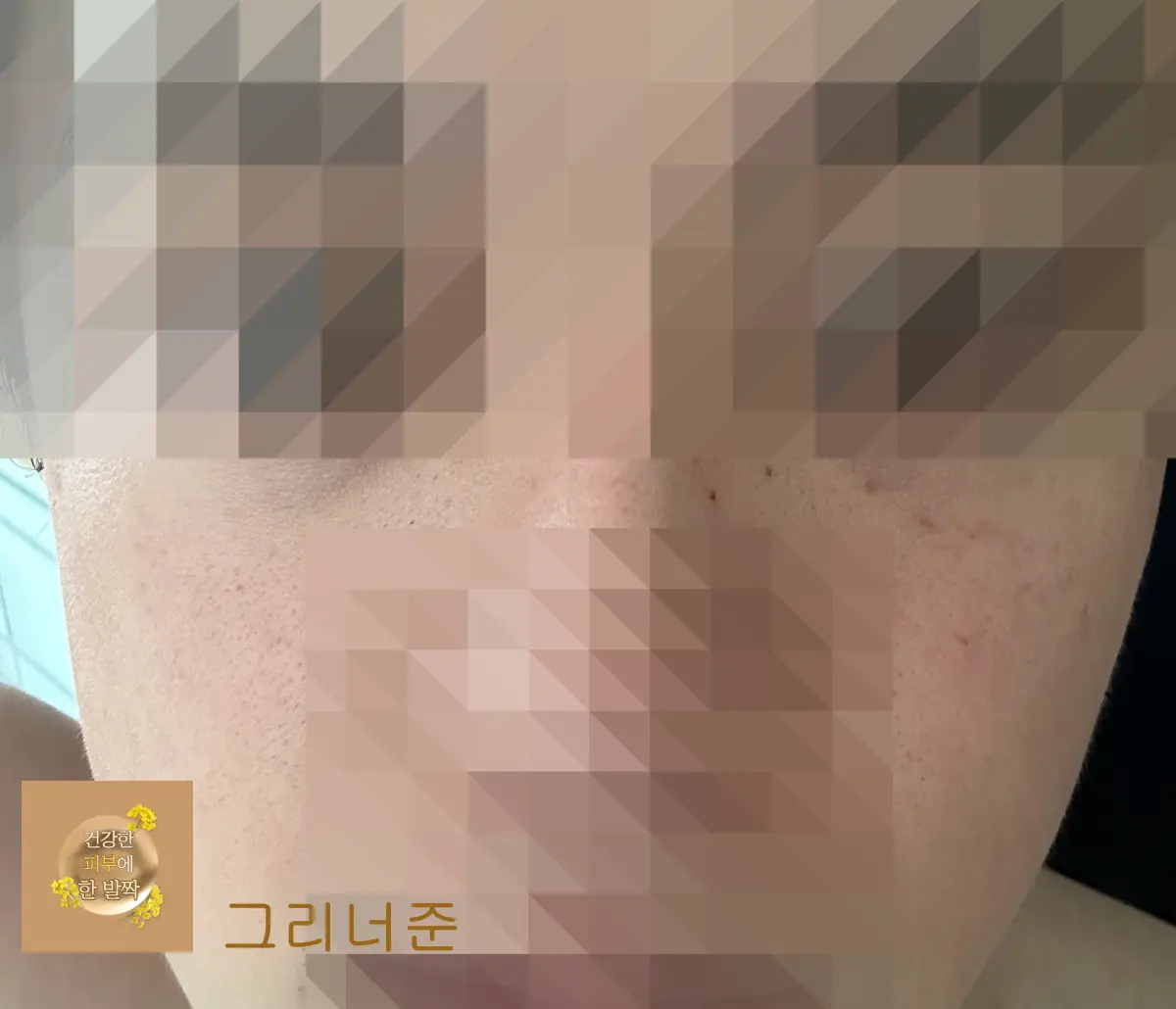 시술-후-3시간-경과-피부-상태