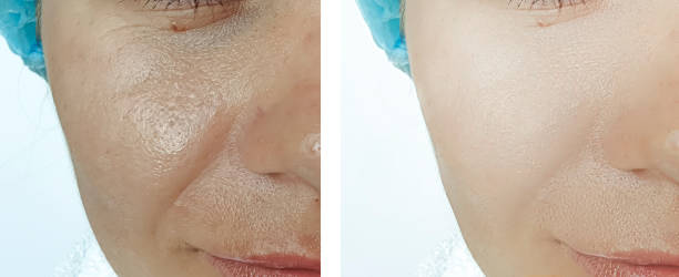 모공축소 관리법