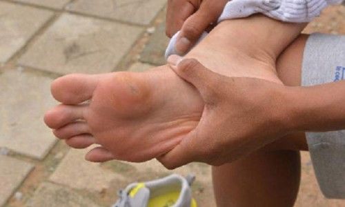 발가락 통풍 증상