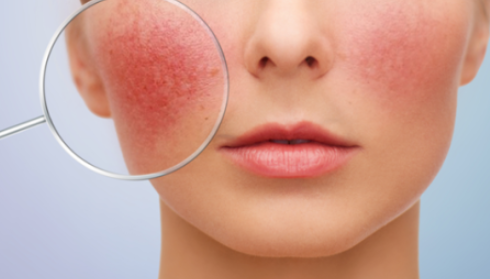 안면홍조증의 주요증상