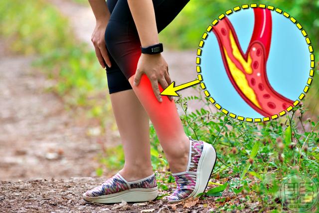 동맥경화 초기증상 종아리 통증