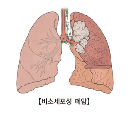 폐암 초기증상