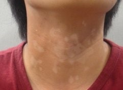 띠니아 베르시 컬러 증상이 나타난 목