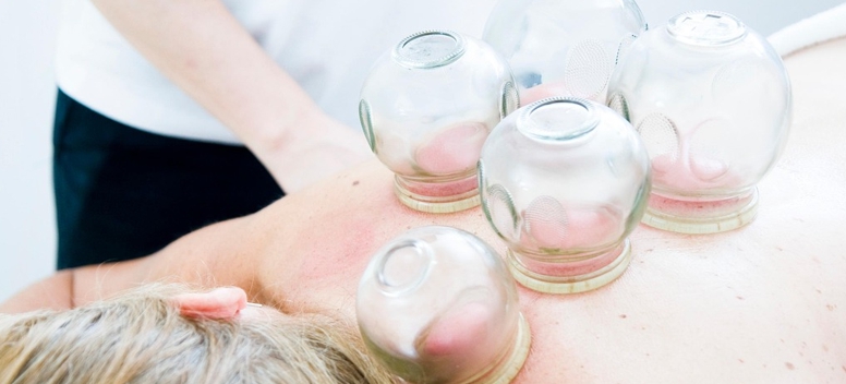 한방 부항-사진