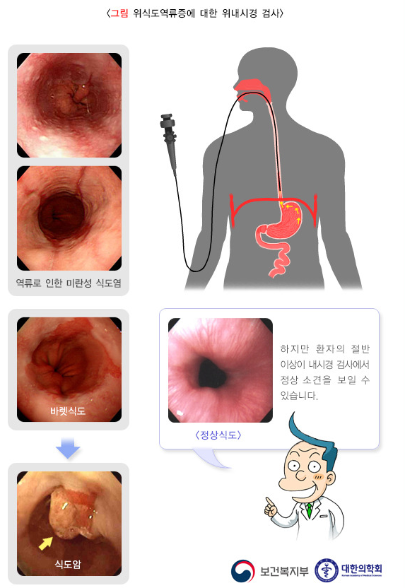 위식도 역류 질환의 원인과 증상, 진단, 치료와 예방 방법, 합병증