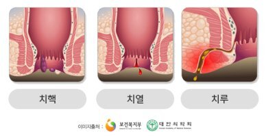 치센