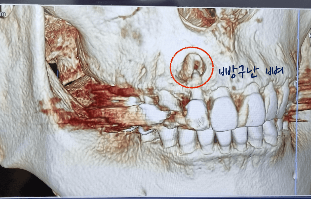 염증으로인한 뼈녹음