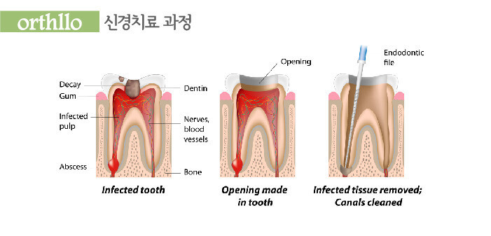 충치 신경치료 디테일한 과정