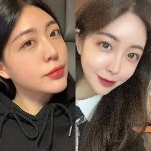 성형 수술 후기