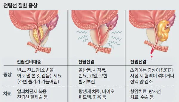 전립선비대증 치료