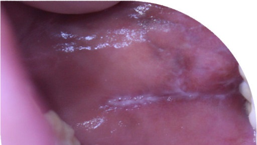 구강 피부염이 아타난 입안