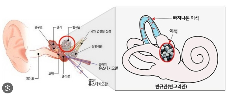 이석증 재발 막는 법