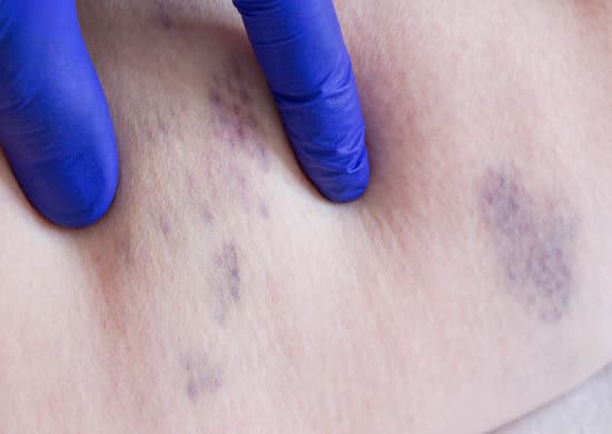 정맥 혈전 (Deep Vein Thrombosis, DVT): 원인과 관리 방법