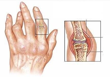 류마티스 관절염 초기증상