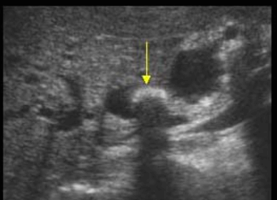 Mirizzi&amp;#39;s syndrom