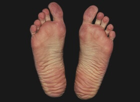 발바닥 굳은살 방지