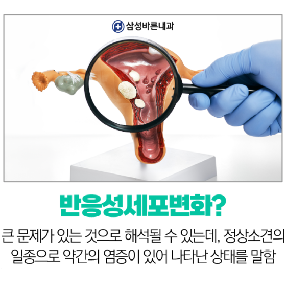 반응성세포변화 HPV 바이러스 자궁경부암검사 염증