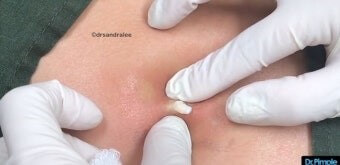 병원의사는-의사야-고름이-든-피부를-사정없이-짜내는-모습