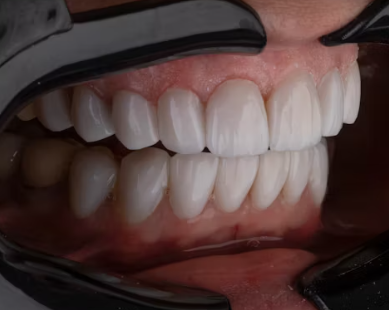 라이나생명 치아보험 청구서류 해지 보장내용