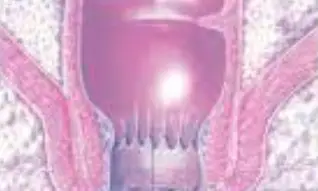 치질-증상-자가치료법-건강