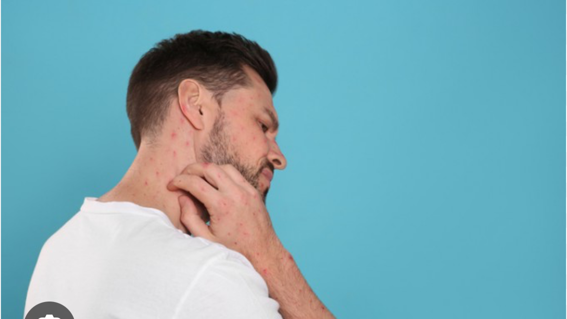 엠폭스-발생국가-발생원인