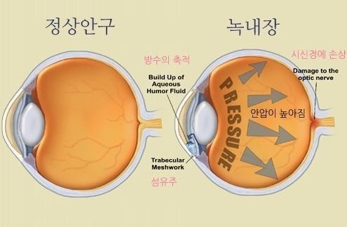 녹내장 약, 가장 중요한 원칙은 &lsquo;수면 직전 점안&rsquo;입니다 관련 사진