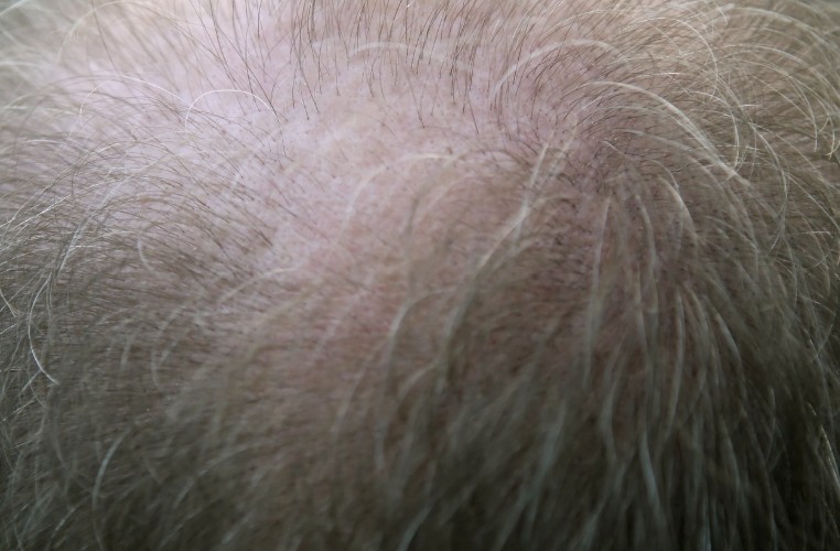 도시 vs 농촌, 탈모율 차이 왜 날까 의 관련 사진