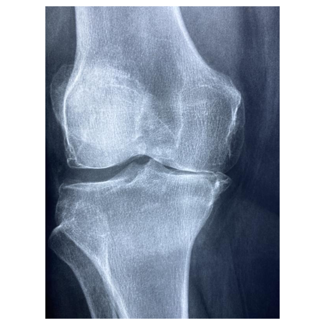 류마티스 관절염과 관련된 사진입니다.