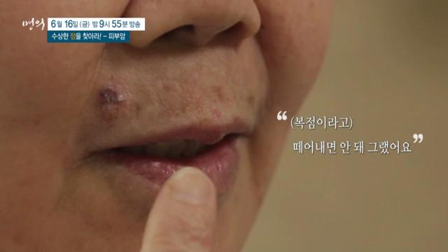 명의 수상한 '점'을 찾아라, 피부암, 악성 흑색종, 예방, 치료 방법