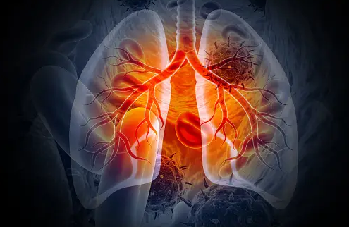 폐암 초기증상 폐결절 폐암원인 예방 금연효과 폐건강 조기검진 호흡기질환 건강관리 조기발견