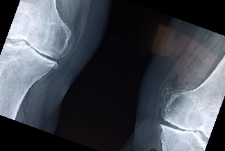 이모튼 캡슐 효능 부작용 가격